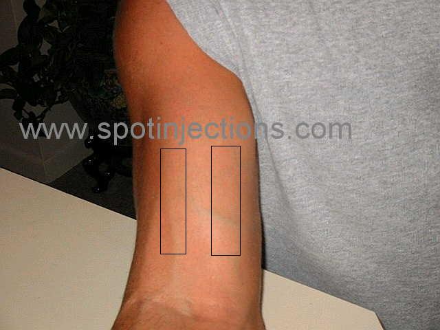 Original watermarked preinjection reference for Bicep Series 3