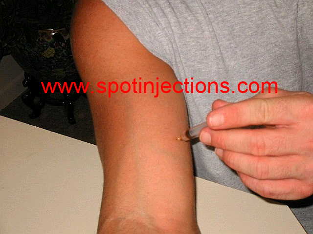 Original watermarked injection reference for Bicep Series 3