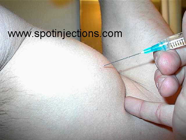 Original watermarked penetration reference for Bicep Series 2