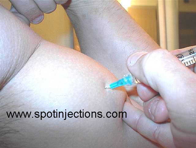 Original watermarked injection reference for Bicep Series 2