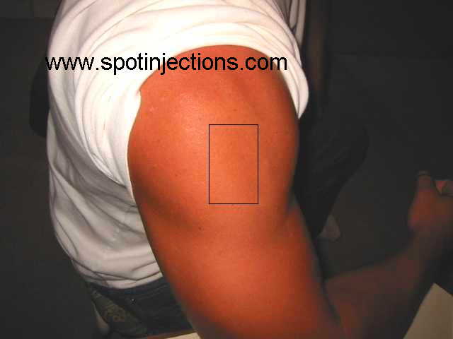 Original watermarked preinjection reference for Delt Series 2