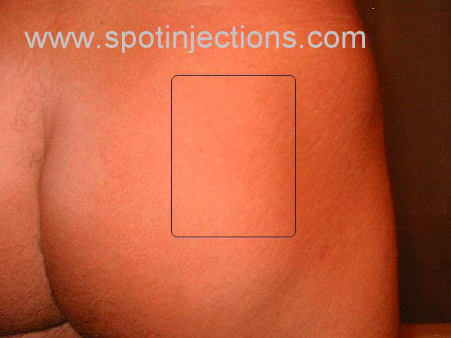 Original watermarked preinjection reference for Glute Series 1