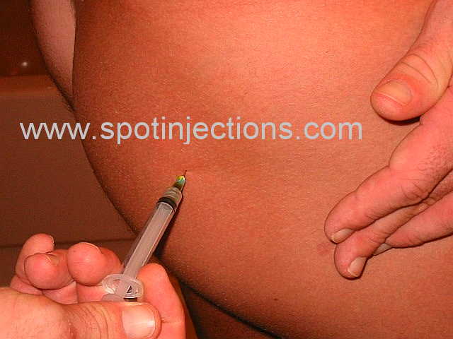 Original watermarked injection reference for Glute Series 1