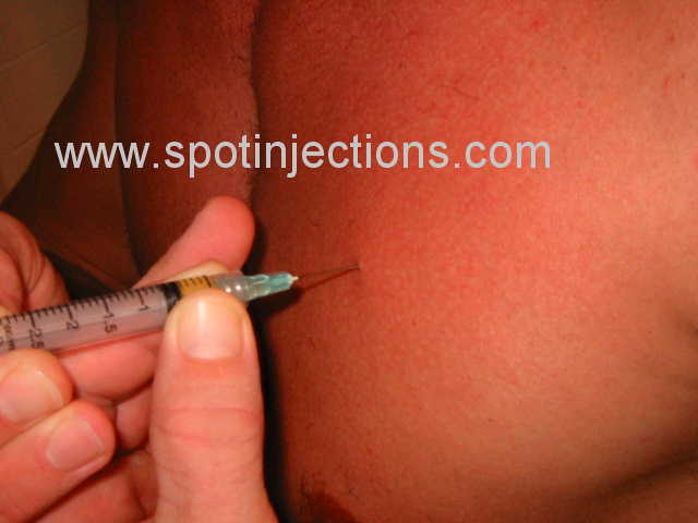 Original watermarked injection reference for Pec Series 3
