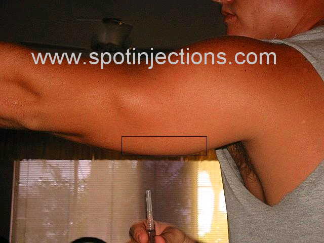 Original watermarked preinjection reference for Tricep Series 3