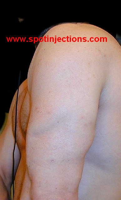 Original watermarked preinjection reference for Tricep Series 2