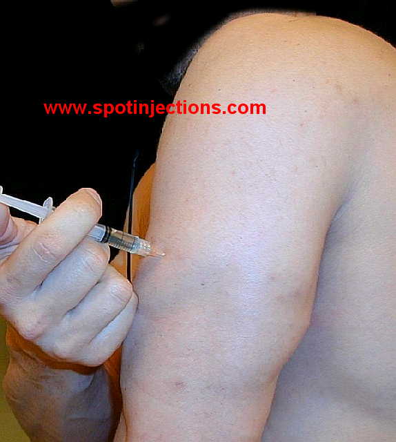 Original watermarked aspiration reference for Tricep Series 2