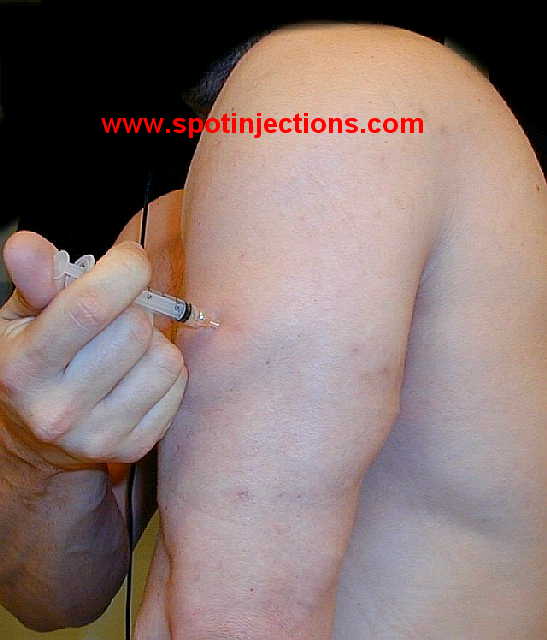 Original watermarked injection reference for Tricep Series 2