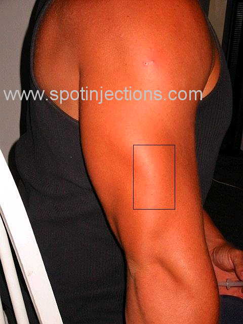 Original watermarked preinjection reference for Tricep Series 1