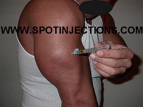 Original watermarked penetration reference for Tricep Series 4