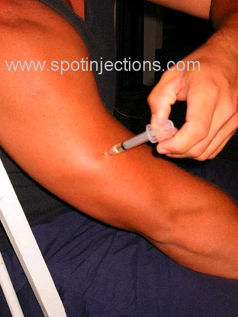 Original watermarked aspiration reference for Tricep Series 1
