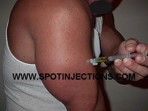 Original watermarked aspiration reference for Tricep Series 4