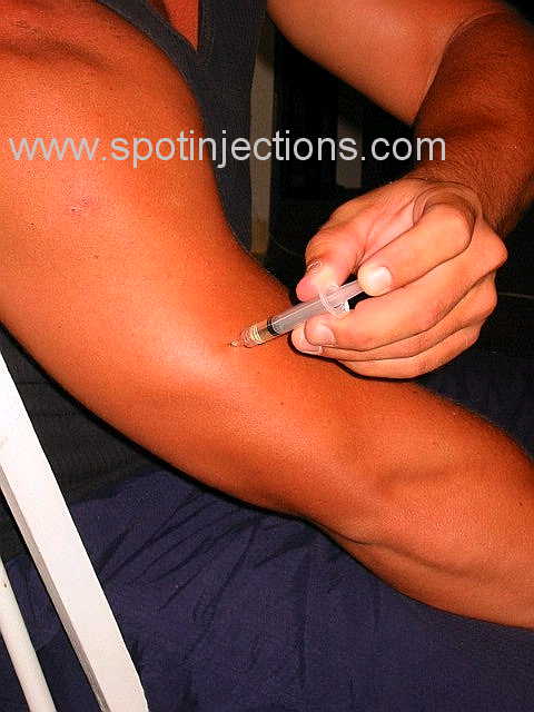 Original watermarked injection reference for Tricep Series 1