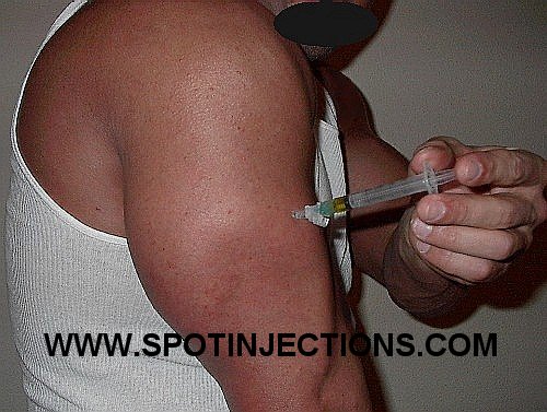 Original watermarked injection reference for Tricep Series 4